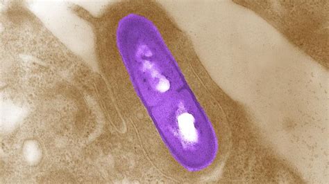 listeria outbreak  michigan kills  symptoms