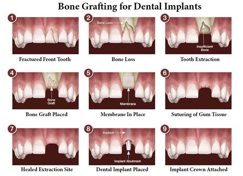 Bone Grafting Psoms