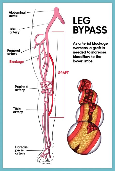 leg bypass surgery  ottawa hospital foundation
