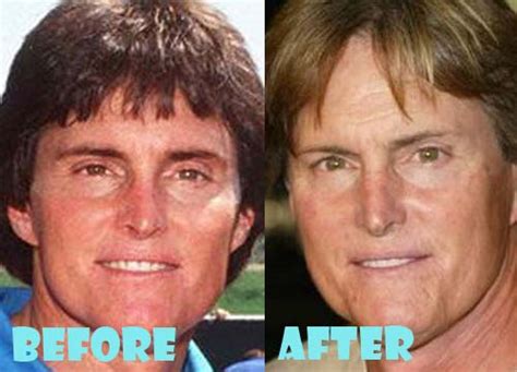 Bruce Jenner Plastic Surgery Before And After Photos