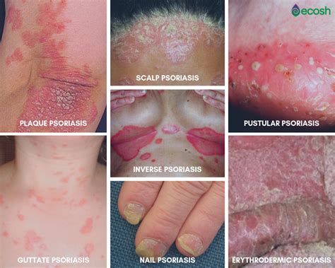 Psoriasis Symptoms Causes Natural Treatment And