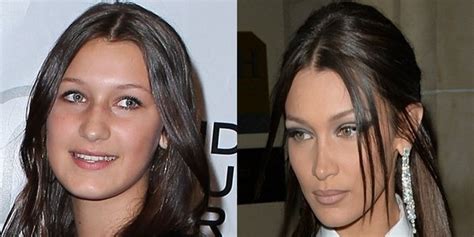 bella hadid s plastic surgery before and after photos