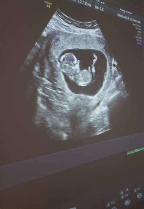 baby   week ultrasound