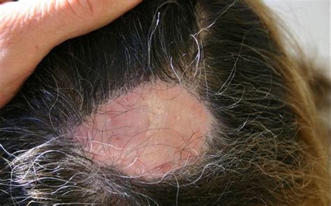 scar repair limmer hair transplant center