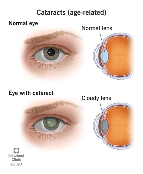 cataracts signs symptoms treatment options