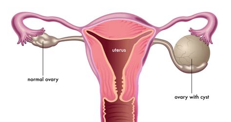 Cysts On Ovaries Causes Symptoms Treatment Prevention