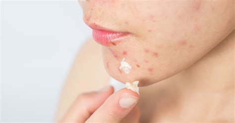 popping  pimple tips  treatments popsugar beauty