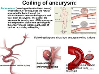 brain aneurysm coiling