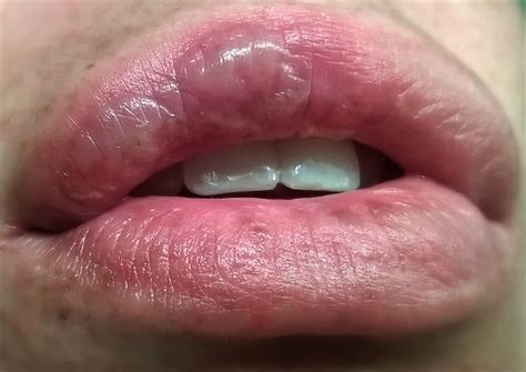 Help Huge Blisters On Lip