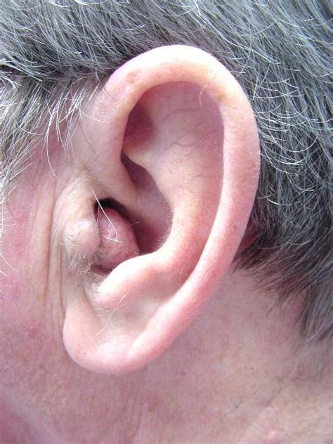 ear canal wikidoc