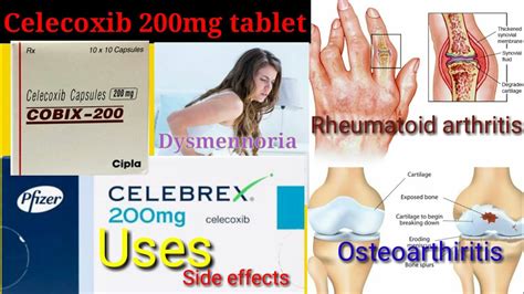 Celecoxib 200mg Capsule Celebrex Cobix Zycel Uses Side Effect Dose