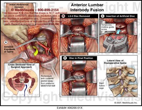 Anterior Lumbar Interbody Fusion Medical Illustration