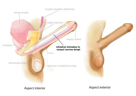 Penile Implant Uretro Genital Reconstruction Center