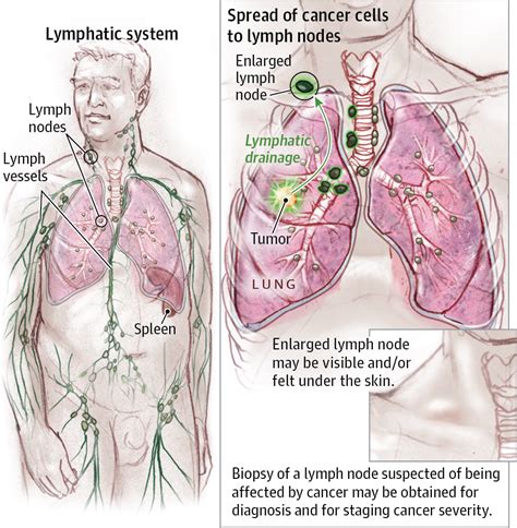 Lymph Nodes And Lymphadenopathy In Cancer Allergy And Clinical