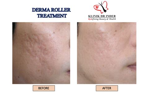 derma roller skin treatment aesthetic clinic malaysia klinik dr inder