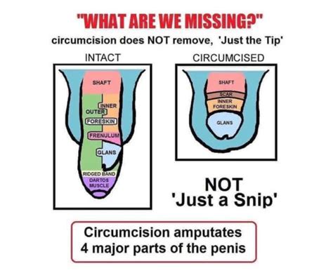 Male Circumcision The Unkindest Cut Masscentral