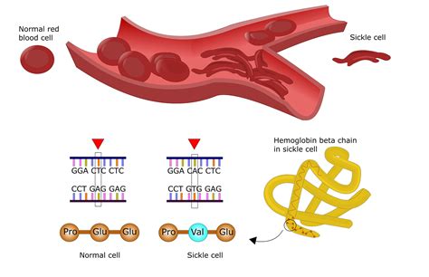 sickle cell disease sickle cell dna
