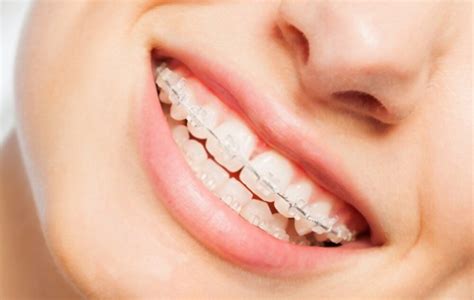 average cost  braces  invisalign  orthodontic place
