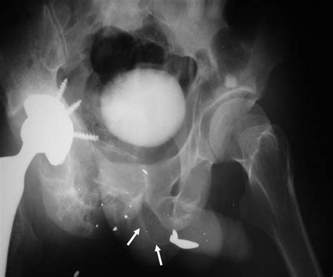 Traumatic Posterior Urethral Fistula To Hip Joint Following Gunshot