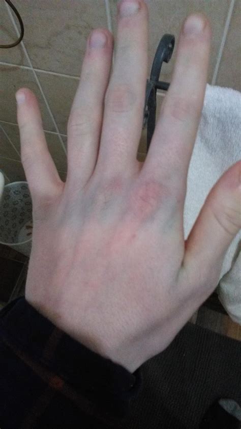 worried  blue hands    light skin medical