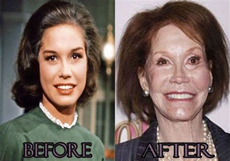 mary tyler moore bad plastic surgery photos celebrity before and after in 2018 pinterest