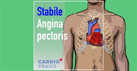 stabile angina pectoris  der regel gute prognose cardiopraxis