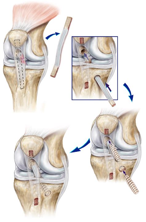Knee Ligament Injuries Tears Of The Anterior Cruciate Ligament Acl