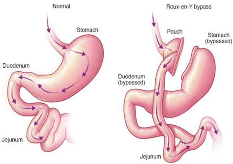 Gastric Bypass Surgery Roux En Y Gastric Bypass Dr