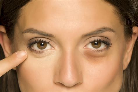 Learn How To Get Rid Of Eye Bags