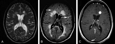 Multiple Sclerosis The Role Of Mr Imaging American Journal Of