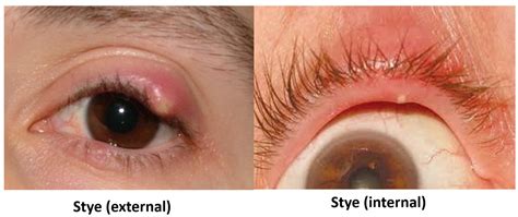 swollen eyelid    remedies  alert signs