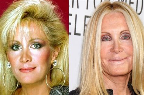 Celebrities Who Took Plastic Surgery Too Far Celebrities