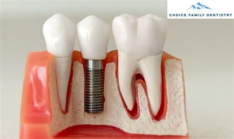 complete guide  dental implants