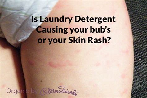 laundry detergent allergy examatri home ideas