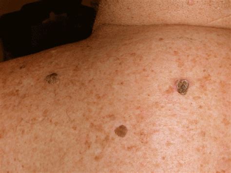 seborrheic keratosis  black spots laser skin seborrheic keratosis