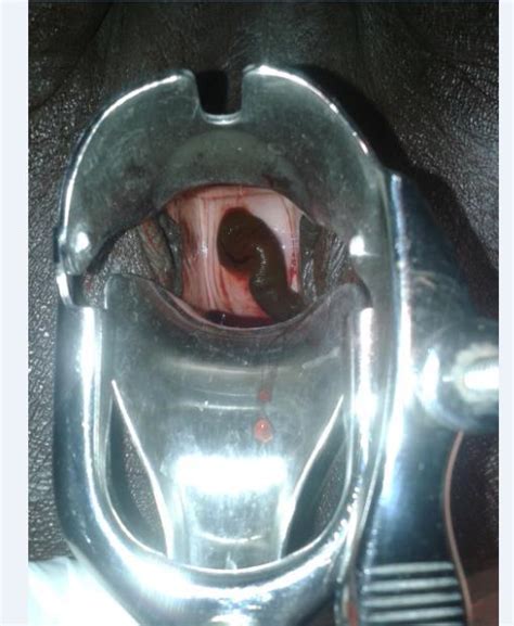 Speculum Exam Showing Leech Attached To Cervical Of A 70 Year Old Woman