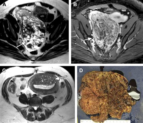 Mr Imaging–pathologic Correlation In Ovarian Cancer