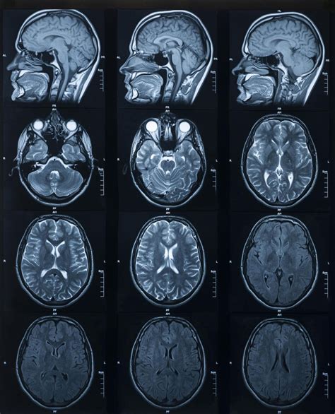 Ultra High Field Mri Provides A Closer Look Of The Hippocampus In Down