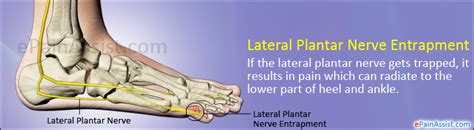 Lateral Plantar Nerve Pain Plant Ideas