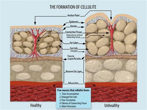 what causes cellulite the better butt challenge