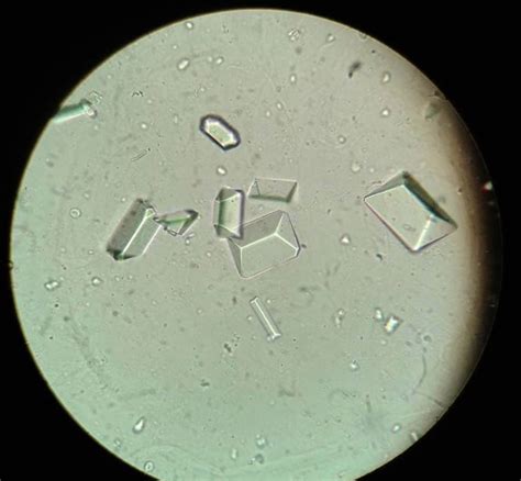 triple phosphate crystals  urine sediment medical laboratories