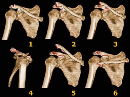 rockwood classification  acromioclavicular joint injury radiology reference article