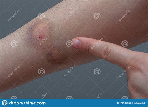 Close Up Of A Colored Bruise On A Woman Arm Stock Image