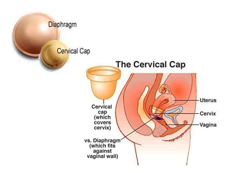 Diaphragm And Cervical Cap Captions Viral Today