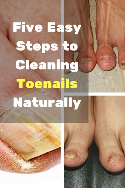 easy steps  cleaning toenails naturally posts  sophia