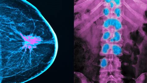 everything you need to know about breast cancer metastasis in bones