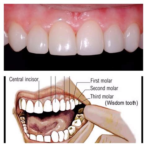 Wisdom Teeth Function Boston Dentist Congress Dental Group 160