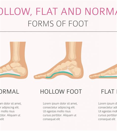 flat feet  children symptoms  treatment