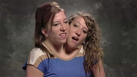 Incredible Story Of The Most Famous Conjoined Twins Page My Xxx Hot Girl