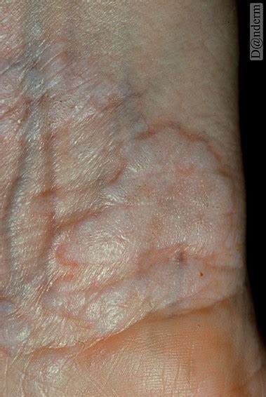 6 92 4 lichen sclerosus et atrophicus white spot disease
